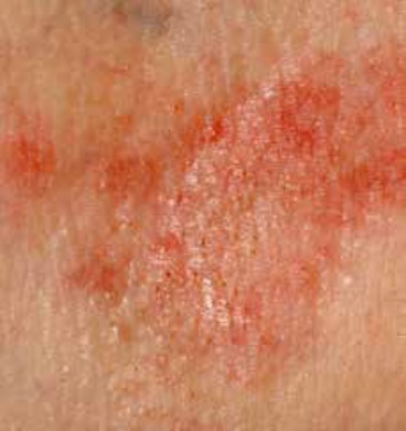 Dermatite Allergica
